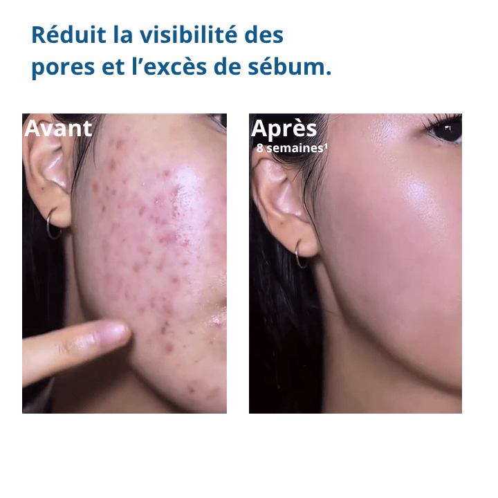 PureSkin™